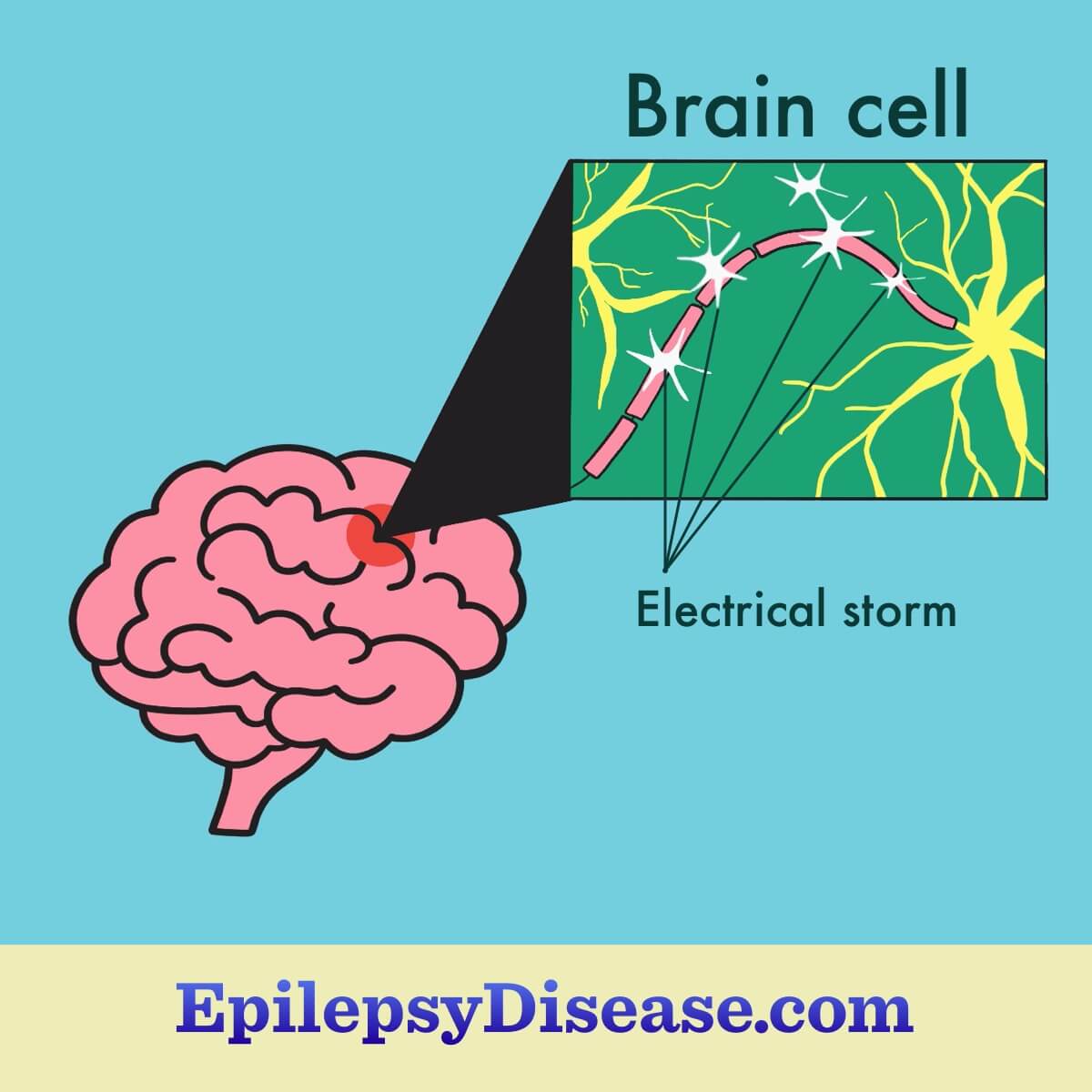 A brain, zoomed in on a brain cell with sparks, indicating an electrical storm