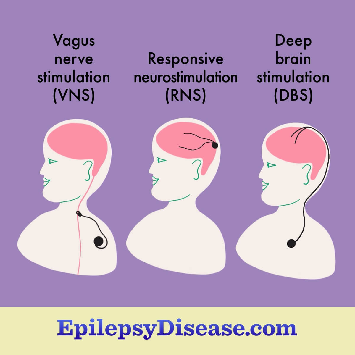 Three people, each with one of the three types of neuromodulation devices, showing where on the body they are implanted