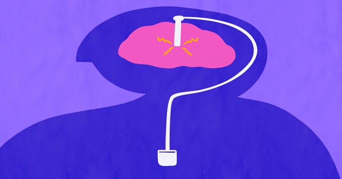 Does Deep Brain Stimulation Treat Lennox-Gastaut Syndrome? image